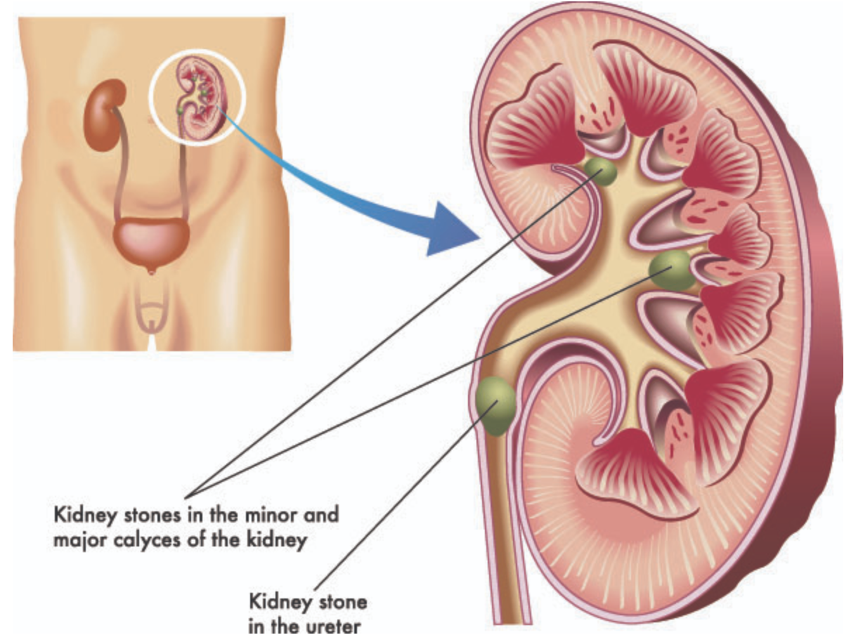 <p><span>Similar to gallstones blocking the outflow of the gallbladder, kidney stones (aka renal calculi) can form in the calyces of the kidneys and move into the ureters, blocking the outflow of the kidneys.</span></p>