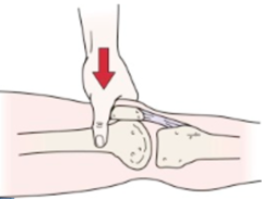 <p>Press proximal patella, resist quadriceps contraction; retropatellar pain indicates patellofemoral dysfunction.</p>