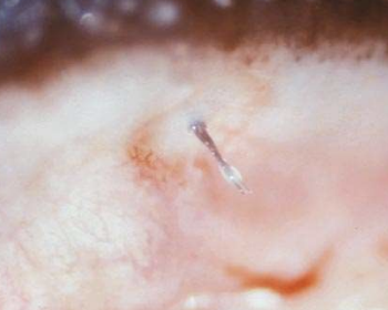 <p>What type of cilia refers to cilia exiting through the palpebral conjunctiva, causing discomfort and corneal erosions or ulcers? It is most common in dogs 1-2 years old and often at the dorsal lid, near the 12 o’clock position. Surgical excision of the follicle is needed.</p>