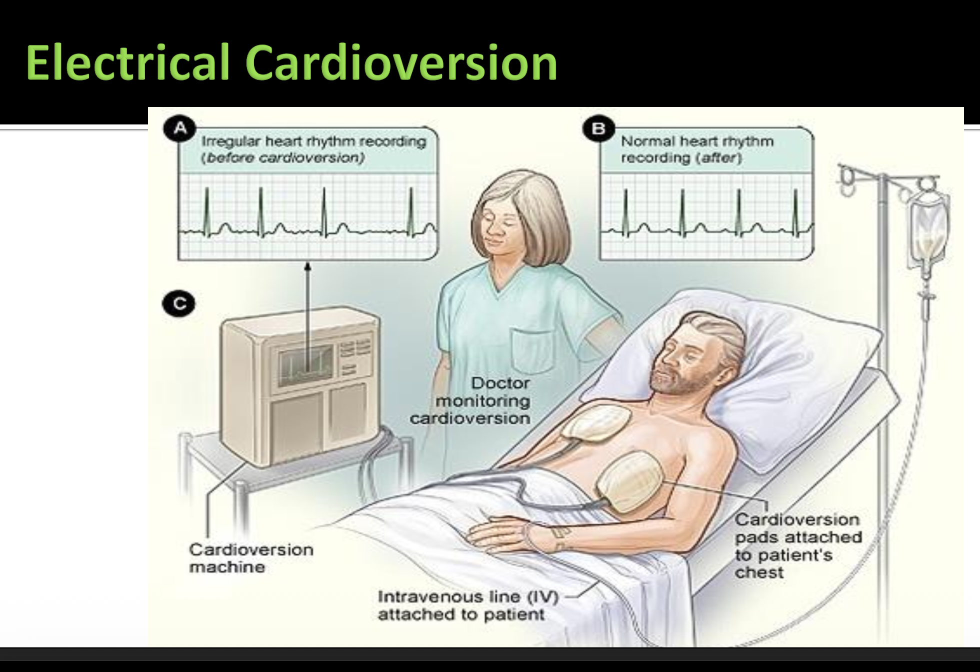<p>Electrical cardioversion</p>