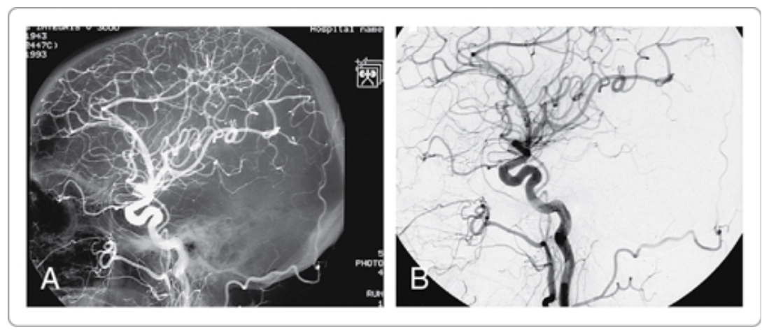 <p>digital subtraction angiography (DSA)</p>