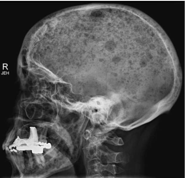 <p>Multiple dark densities that are similar in size (“punched out lesion”); can cause pathological collapse (vertebral plana); associated with “rain drop skull” </p>