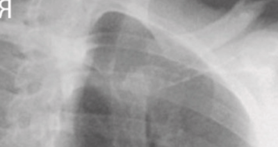 <p><span style="background-color: transparent;">Oblique SC Joint</span></p>