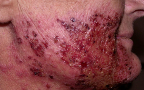 <p>radiation therapy induced </p>