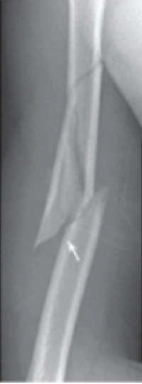 <p>Produces a new or abnormal bone alignment. </p>