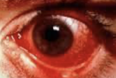 <p>Si me llega un paciente con esta patología conocida como “ojo rosa” más fiebre alta, vómito, petequias púrpuras. En que patología piensan y que bacteria puede estar causándola?</p>