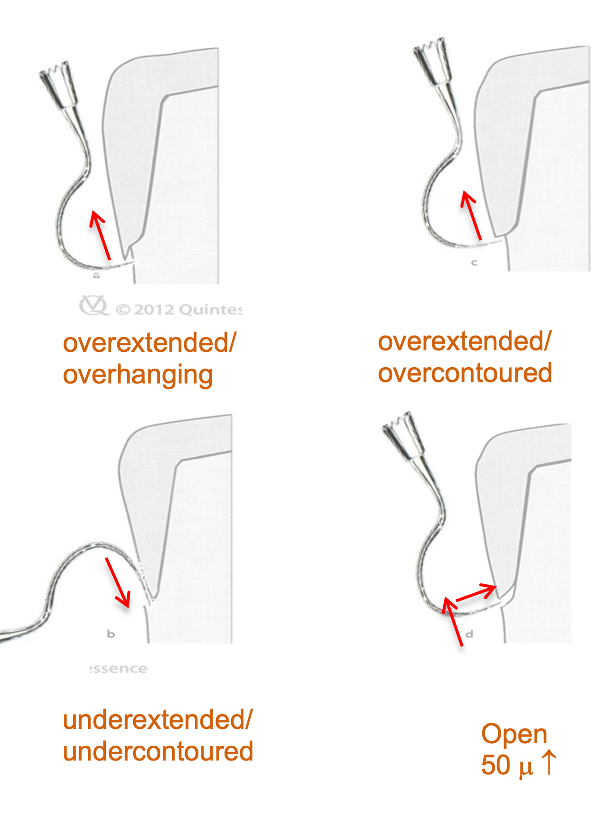 <ul><li><p>Overextended/overhanging</p></li><li><p>Overextended/overcontoured</p></li><li><p>Underextended/undercontoured</p></li><li><p>Open (over 50µ)</p></li></ul><p></p>