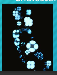 <ul><li><p>microscopic technique to check form Maltese cross formation which indicates what metabolite</p></li></ul><p></p>