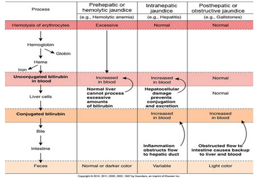 <ul><li><p><span style="background-color: transparent;"><strong>Jaundice </strong>- Yellow staining of skin and eyes due to excessive bilirubin in circulation.</span></p></li><li><p><span style="background-color: transparent;"><strong>Pre-hepatic - </strong>excessive RBC breakdown</span></p></li><li><p><span style="background-color: transparent;"><strong>Hepatic - </strong>hepatocyte damage</span></p></li><li><p><span style="background-color: transparent;"><strong>Post-hepatic - </strong>obstructive, bile cannot flow</span></p></li></ul><p></p>
