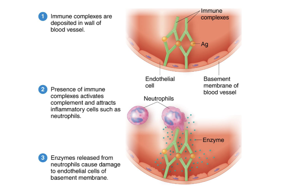 <p>(Immune complex)</p><ul><li><p>3-8 hours</p></li><li><p>Antibodies form against soluble antigens in the serum </p></li><li><p>form immune complexes that lodge in the basement membranes beneath the cells </p><ul><li><p>activate complement, causing inflammation </p></li></ul></li></ul><ul><li><p>Arthus reactions, serum sickness</p></li></ul><p></p>