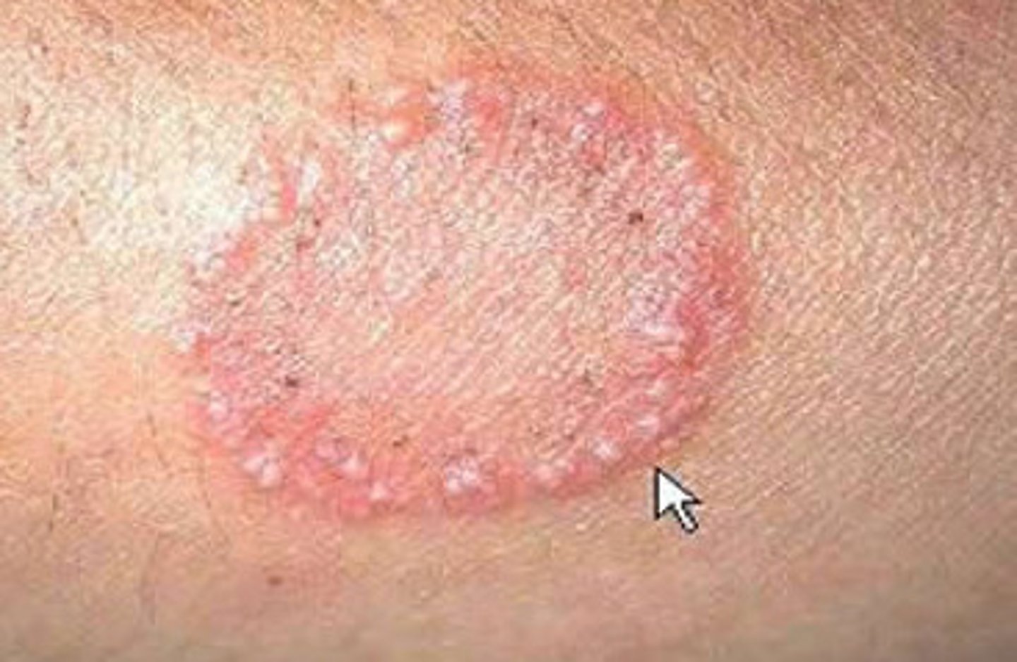 <p>ringworm; fungus</p>