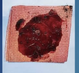 <p>Fresh Red Blood</p><p>Appears quickly after surgery</p><p>Good Sign if its a light consistant draining </p>