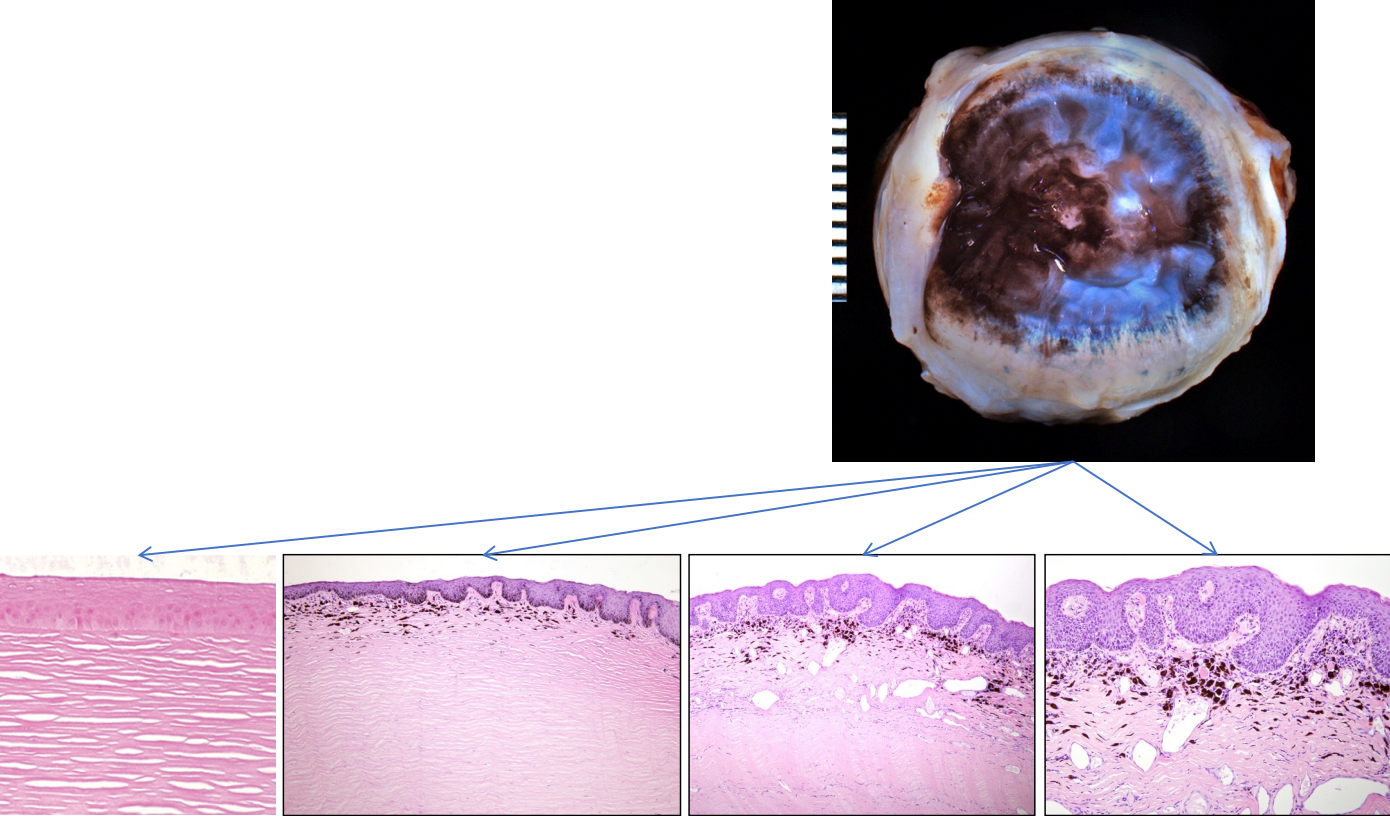 <p>not specific to KCS — any chronic, end-stage corneal disease</p><ul><li><p>epithelial thickening with keratinization (↑ opacity)</p></li><li><p>rete ridge formation</p></li><li><p>pigmentation of the epithelium & superficial stroma</p></li><li><p>superficial neovascularization</p></li><li><p>superficial inflammation</p></li><li><p>goblet cell hyperplasia (conjunctiva)</p></li></ul><p></p>
