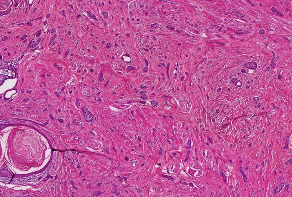 <p>Tumeur du mamelon : diagnostic </p>