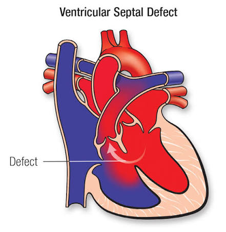 <p>ventricular septal defect (VSD) definition</p><ul><li><p>may _ spontaneously in 1st year</p></li><li><p>if large, what is a finding?</p></li></ul><p></p>