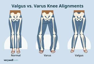 <p>Distal segment moves away from the body's midline.</p><ul><li><p>Example: knee valgus</p></li></ul><p></p>