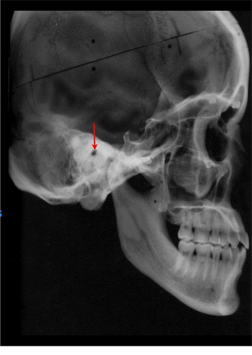 <p>which anatomical landmark:</p><p>- Highest point of the ear canal</p><p>- Most superior point of the external auditory meatus</p><p>- Immediately distal to the condyle</p>