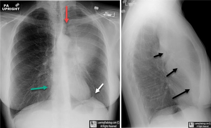 <p>Frontal view: Luftschiel sign, not always present. <br>Lateral view: anterior displacement of major fissure and anterior collapsed lung</p>