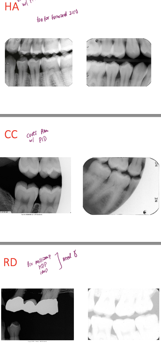 <p>HA = beam not lined up w film at right hor angle</p><p></p><p>CC = film not covered by whole PID</p><p></p><p>RD (radiographic density) = fix mA, kdp, exposure time (8)</p><ul><li><p>Too dark → decrease mA, kVp, or exposure time.</p></li><li><p>Too light → increase mA, kVp, or exposure time.</p></li></ul><p></p><p>inc mA (quantity of xrays) = dark</p><p>inc kVp (E/penetrate power of xrays) = dark + change contrast</p><p>time = darker</p><p></p><p>if mA too high (dark) can compensate by dec time </p><p>changing one doesn’t affect each other</p><p></p><p></p>