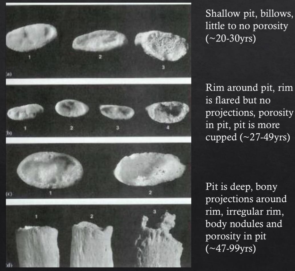<p>Billowy to marked, flat to cupped</p><p>~20-30 yrs: Shallow pit, billows</p><p>~27-49 yrs: Rim around pit, rim is flared, no projections </p><p>~47-99 yrs: Pit is deep, bony projections around rim, irregular rim, body nodules</p>