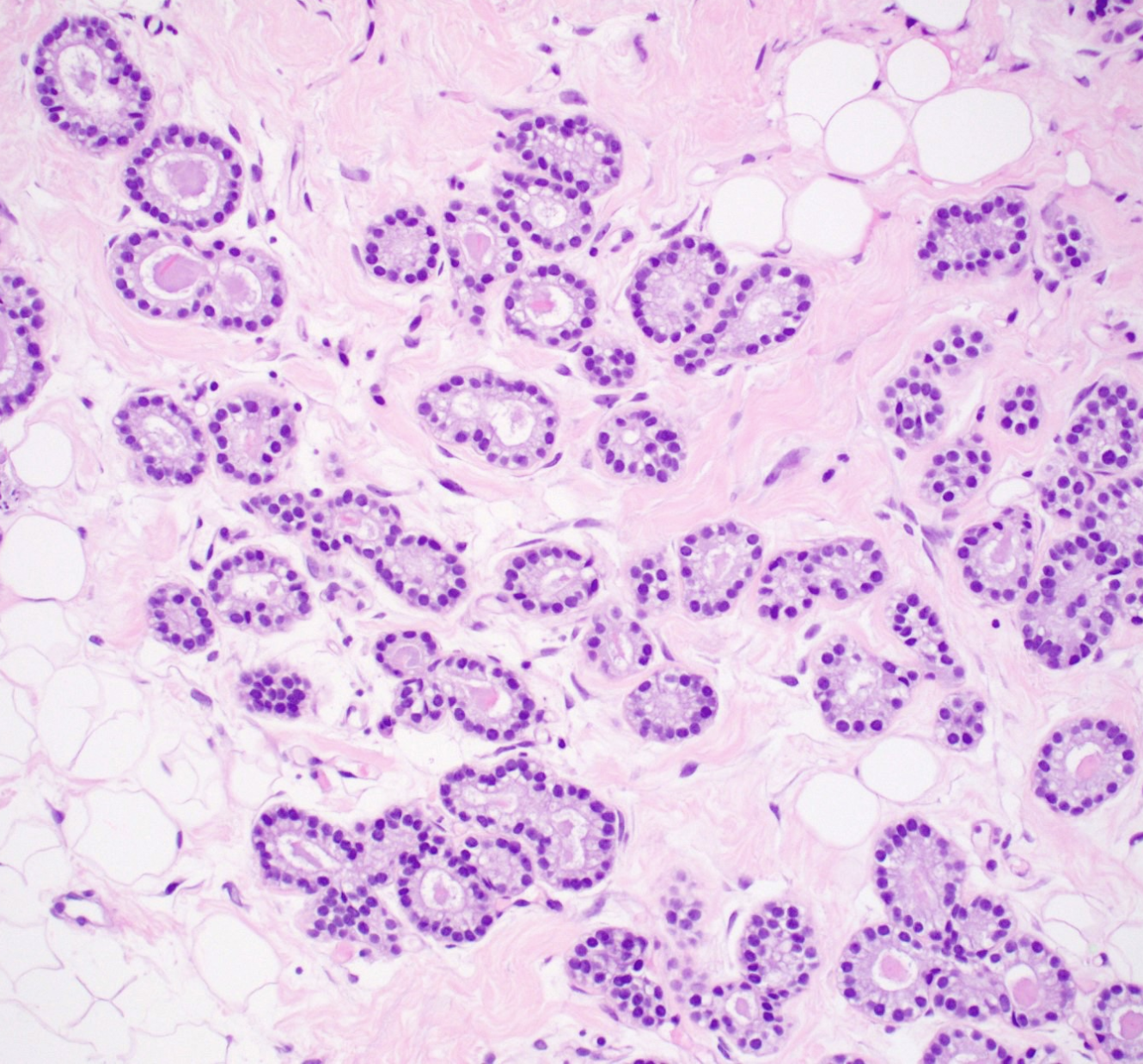 <p>1) diagnostic </p><p>2) morphologie</p><p>3) IHC</p><p>4) DD avec carcinome tubuleux </p>