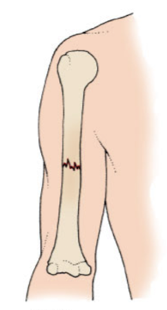 <p>does not extend through the skin, no visible wound</p>