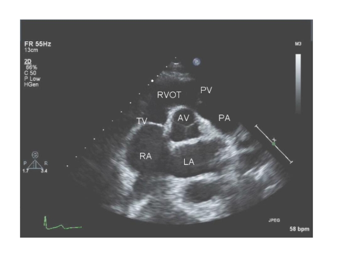 <p><span style="color: rgb(8, 143, 61);"><strong>The LA appendage can be imaged from this view by a slightly Lateral angulation and Superior rotation of the transducer.</strong></span></p>