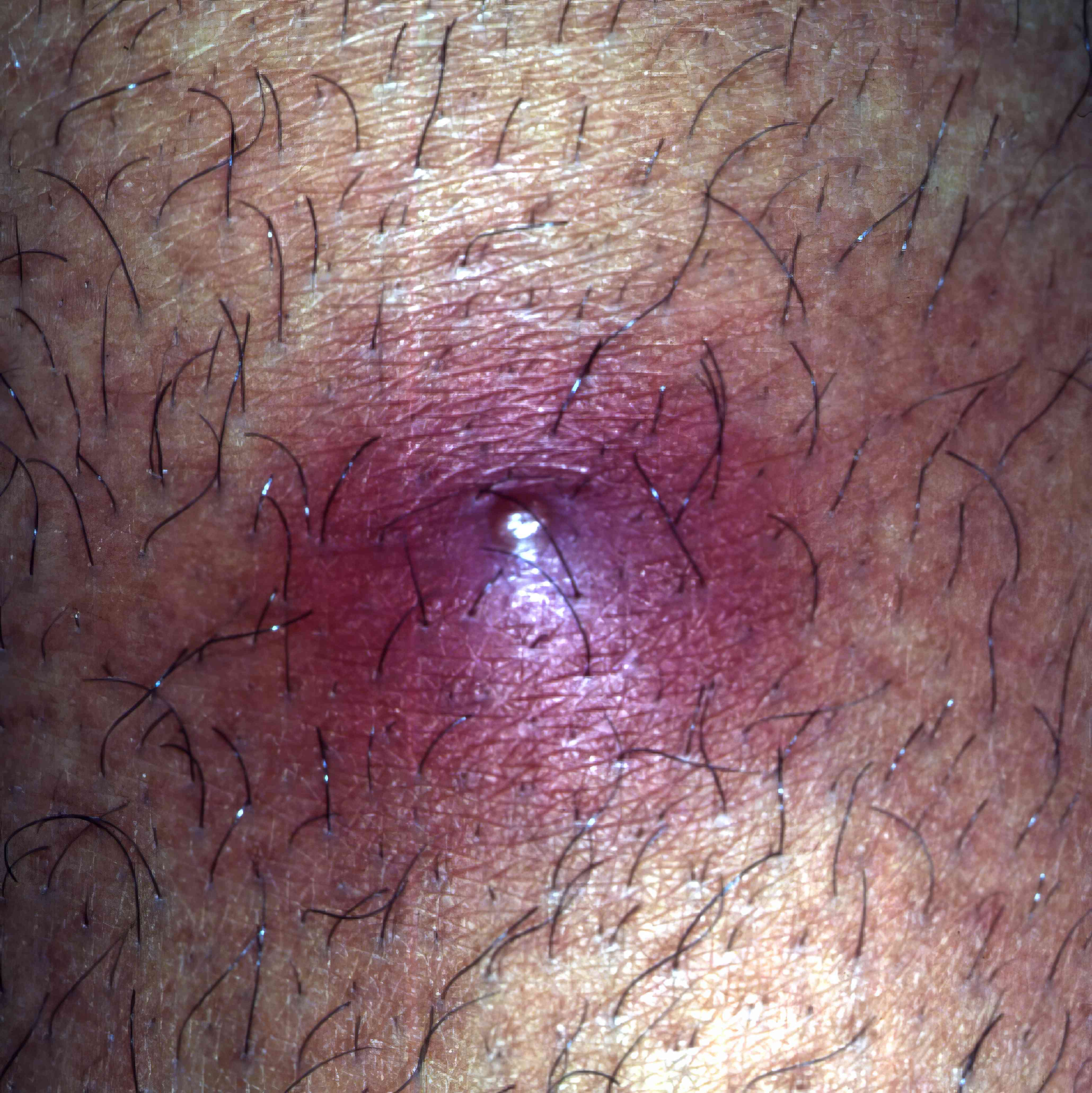 <p>A deeper infection of a hair follicle that forms a painful boil.</p>