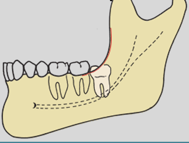 <p>approx ½ of the crown is covered by the border of the ramus</p>