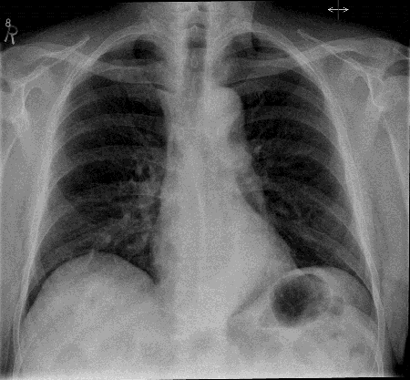 <p><span>Male. 75 years. Cough and a slight fever – over the last</span><br><span>week.</span></p>