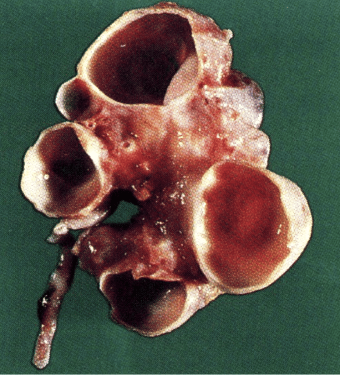 <p>Renal cystic dysplasia</p>
