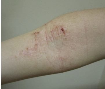 <p>Itchy, dry, eczematous patches with lichenification that are classically seen in the flexor creases </p><p>-Dx: clinical, serum IgE may be elevated </p><p>-Tx: topical corticosteroids and emollients </p>