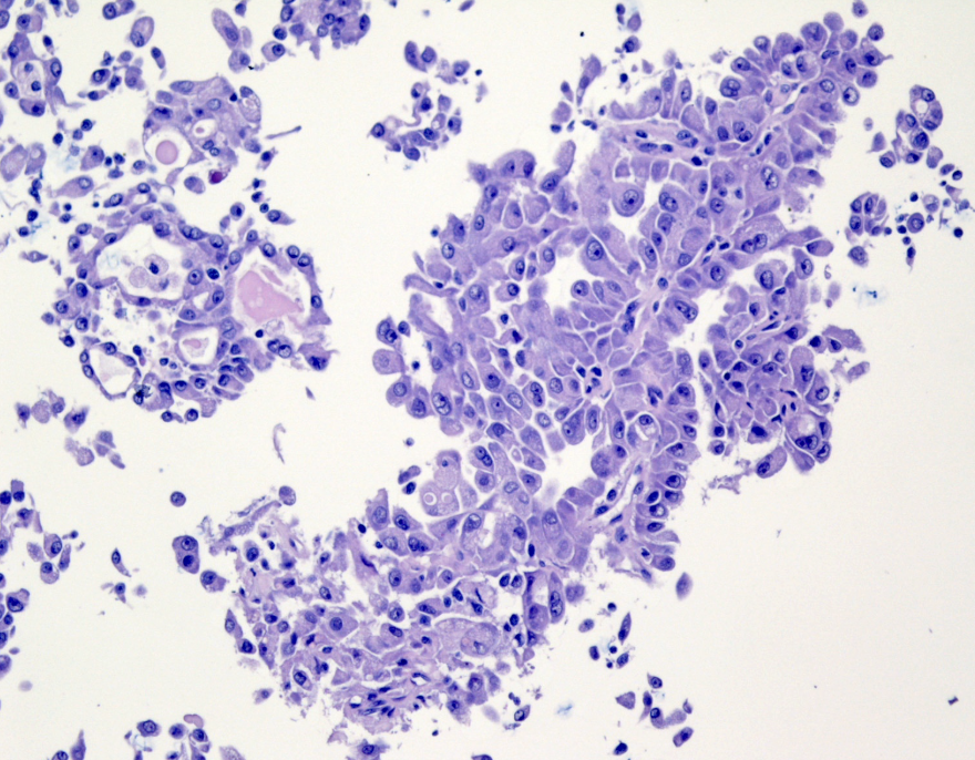 <p>Cytologie salivaire</p><p>1) Catégorie selon Milan</p><p>2) Diagnostic</p>