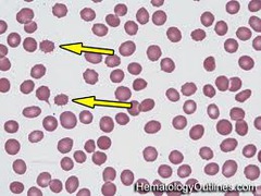 <p>Membrane defect. Severe liver disease, abetalipoproteinemia.</p>