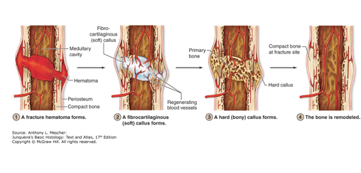 <ul><li><p>Bone repair and growth involve the continuous resorption of previously formed bone tissue and the simultaneous laying down of new bone at a rate that exceeds removal.</p></li><li><p><span style="color: red;">Osteoclasts</span> (large, multinucleated, motile cells) handle <span style="color: rgb(255, 255, 255);"><strong>matrix resorption and remodeling.</strong></span></p></li><li><p>This fracture repair process relies on <span style="color: red;">osteogenesis</span>= sum of osteoblasts and osteoclast activities.</p></li></ul><p></p><ol><li><p>A fracture hematoma forms</p></li><li><p>Fibrocartilaginous (soft callus forms)</p></li><li><p>Hard (bony) callus forms</p></li><li><p>Bone is remodeled</p></li></ol><p></p>