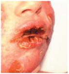 <p>Bullous impetigo ; exfoliative toxin A and B ; <span style="font-size: calc(var(--scale-factor)*18.00px);">Staphylococcal</span></p>