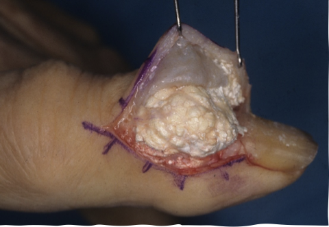 <p>massive accumulations of uric acid </p>