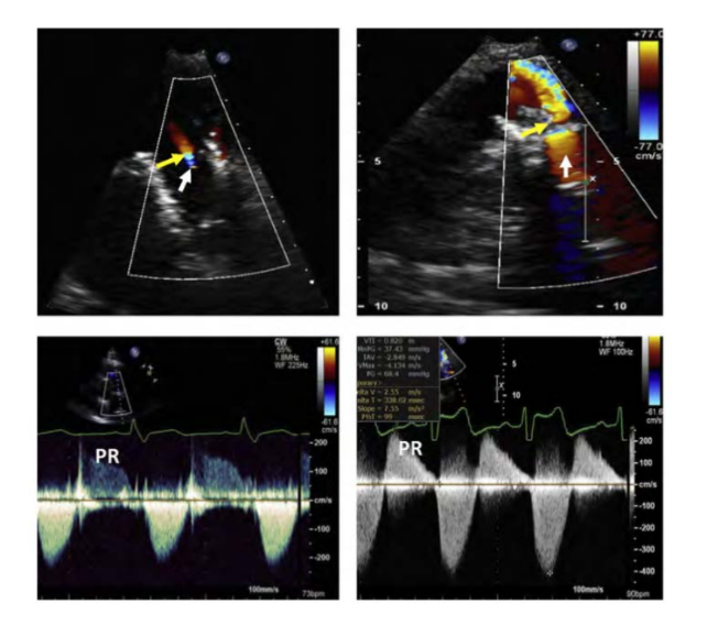 <p>The type and size of prosthesis</p><p> The presence of relevant anatomic abnormalities, such as degeneration or</p><p>vegetations</p><p> Quantitation of severity of regurgitation</p><p> Any changes from previous assessments in serial exams</p><p> Assessment of the RV size and interventricular septal position and motion during diastole is needed</p>