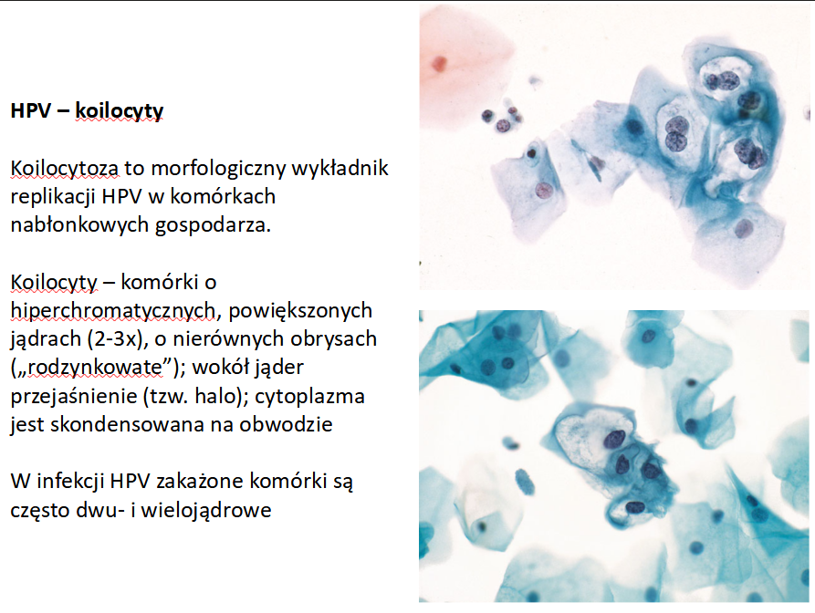 <p>B. Kłykcina kończysta</p><p></p><p>koilocyty - <strong>typowy marker zakażenia wirusem HPV</strong> (Human Papilloma Virus)</p>