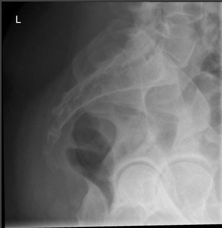 <p>critique for sacrum lateral </p>