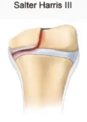 <p>fracture across the physis which extends into the epiphysis (and therefore articular surface)</p>