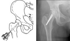 <p>Core decompression is a surgical procedure that involves surgical drilling into the area of dead bone near the joint. This reduces pressure, allows for increased blood flow, and slows or stops bone and/or joint destruction. Core decompression is commonly performed to treat osteonecrosis.</p>