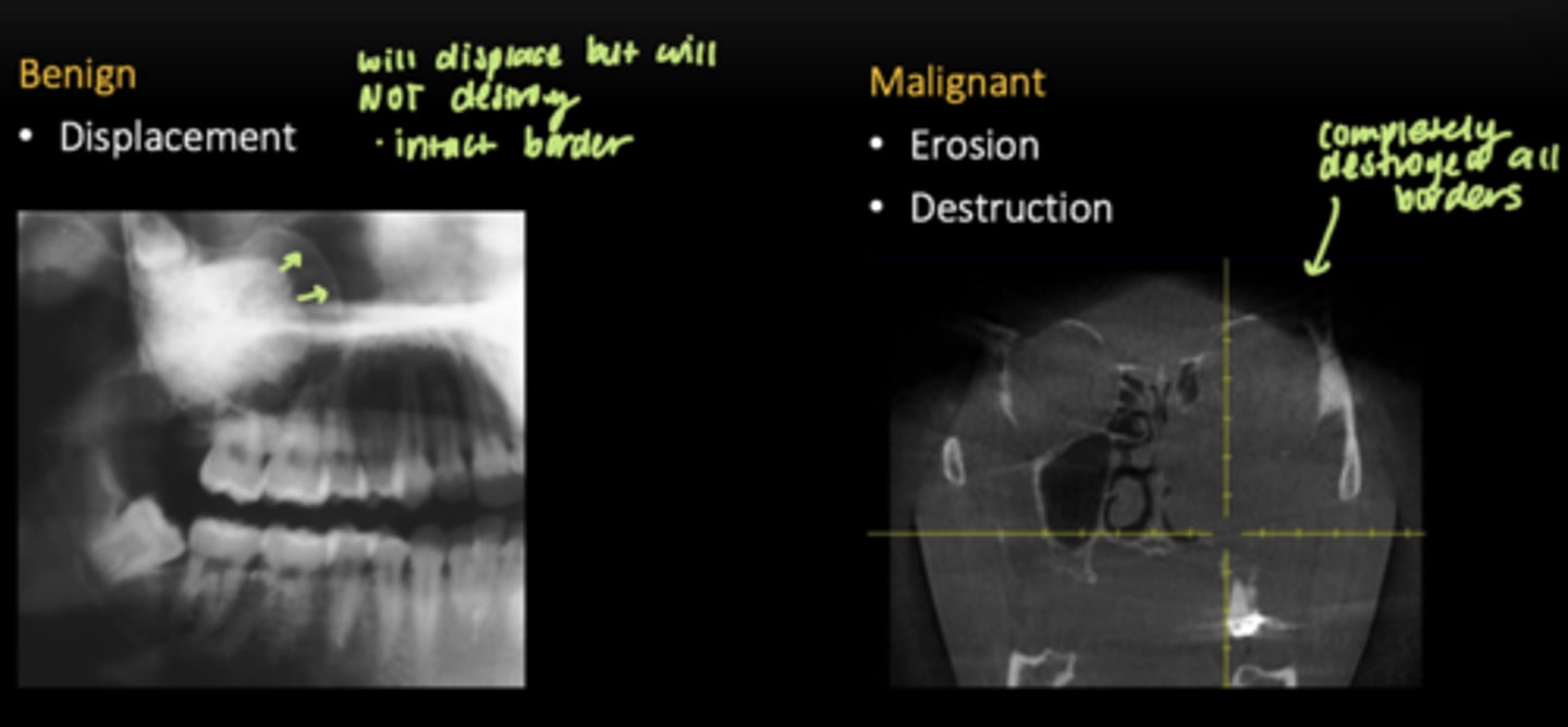 <p>Benign: </p><p>- Displacement </p><p>Malignant: </p><p>- Erosion </p><p>- Destruction </p>