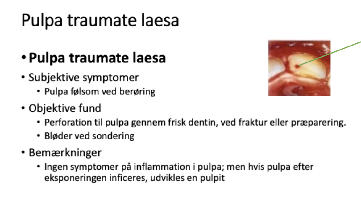 <p>En diagnose der betegner at pulpa er eksponeret</p><ul><li><p><span>Det bløder hvis man prikker med en sonde</span></p></li><li><p><span>Ingen inflammation endnu, men det kan ske hvis det herefter inficeres --> udvikler en pulpit=betændelsesreaktion i pulpa med bakterier</span></p></li></ul><p></p>
