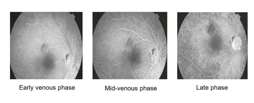 <ul><li><p>Early venous phase: Begins 13–15 sec, laminar venous filling; veins fully fill by ~45 sec.</p></li><li><p>Mid‑venous phase: Arterioles fade; veins continue to fill.</p></li><li><p>Late venous phase: Arterioles pale; veins fully filled; fluorescence gradually fades from both retina and choroid.</p></li></ul><p></p>
