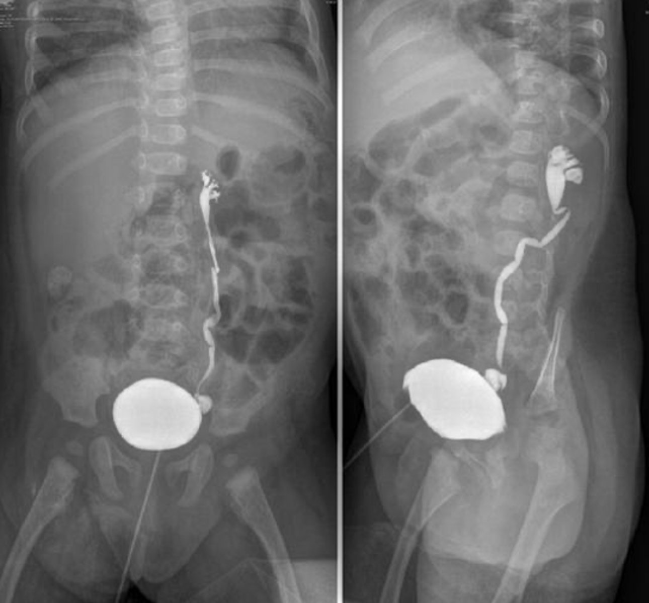 <p>Renal bladder ultrasound (RBUS): often initial diagnostic and may show hydronephrosis and hydroureter</p><p>Voiding cystourethrography (VCUG): gold standard for diagnostic and grading of retrograde flow</p>