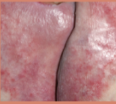 <p>caused by moisture not pressure/shear force</p><ul><li><p>skin is damp and not necessarily located on bony prominences</p></li><li><p>often misclassified as pressure ulcures</p><ul><li><p>there can be a combo of pressure and moisture damage</p></li></ul></li></ul><p></p>