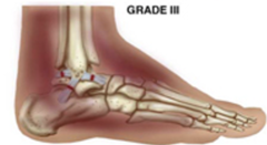 <p>- Complete disruption</p><p>- Joint unstable</p><p>treatment: orthopedic consult for surgical repair</p>