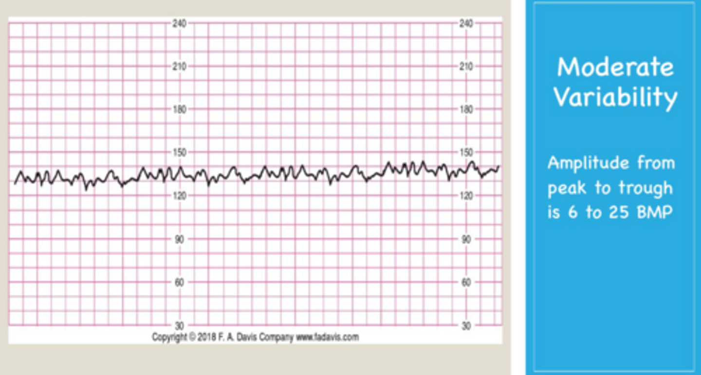 <p>A baseline heart rate above 160 beats per minute.</p>