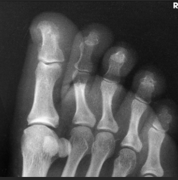 <p>When radiographing the 1st-2nd toes, which oblique should be used?</p>